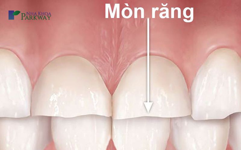 Nguyên nhân răng bị ê buốt khi nhai là gì?