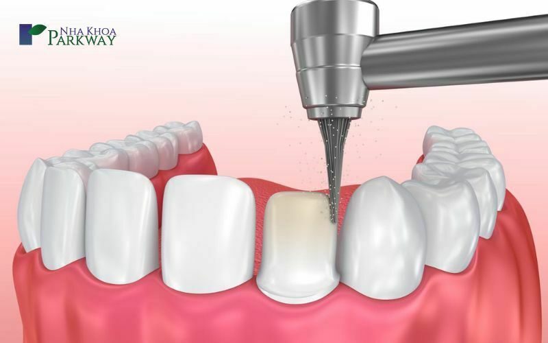 Răng bị ê buốt do sau khi làm một vài thủ thuật nha khoa