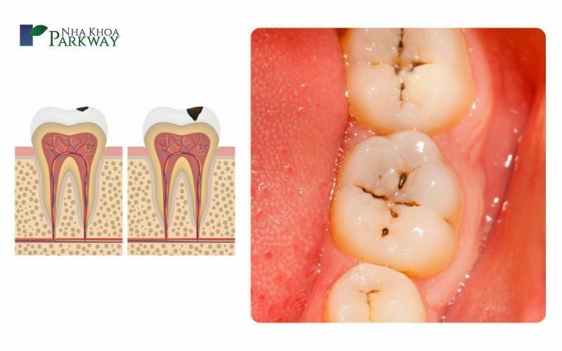 Những nguyên nhân gây ra răng đen ở kẽ