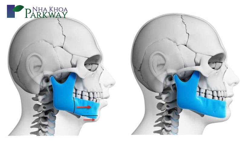 Điều kiện để thực hiện một ca niềng răng thành công