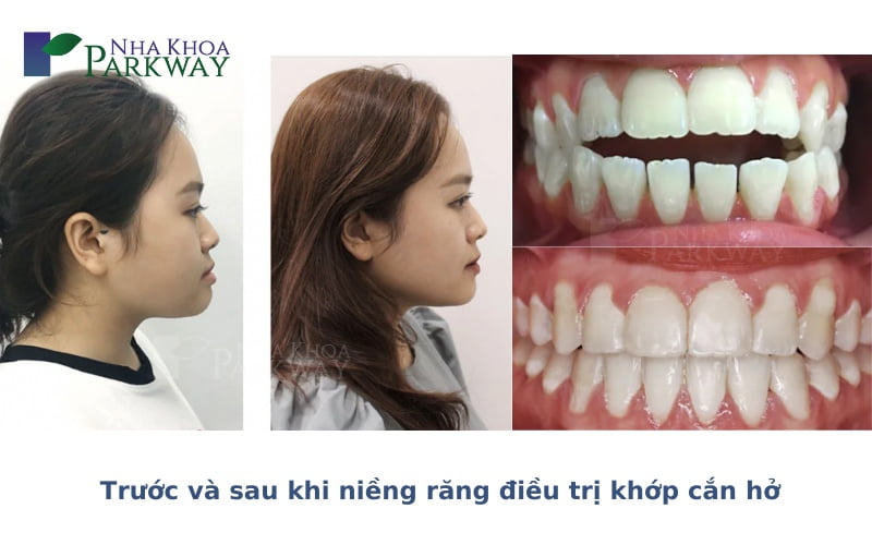 Khuôn mặt trước và sau khi niềng răng hô đối với mỗi trường hợp khác nhau