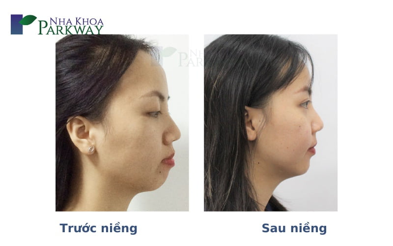 Khuôn mặt trước và sau khi niềng răng ở từng độ tuổi 