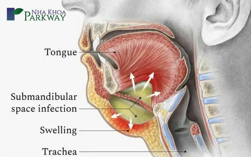 Áp xe răng ở trẻ em có nguy hiểm không?