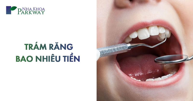 bảng giá trám răng bao nhiêu tiền 1 cái