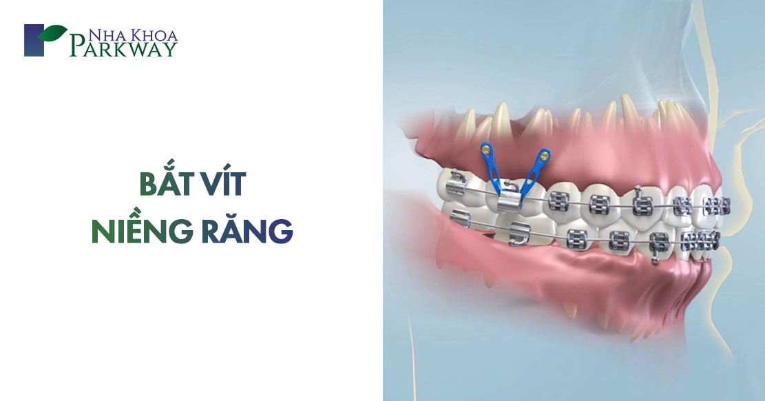 bắt vít niềng răng