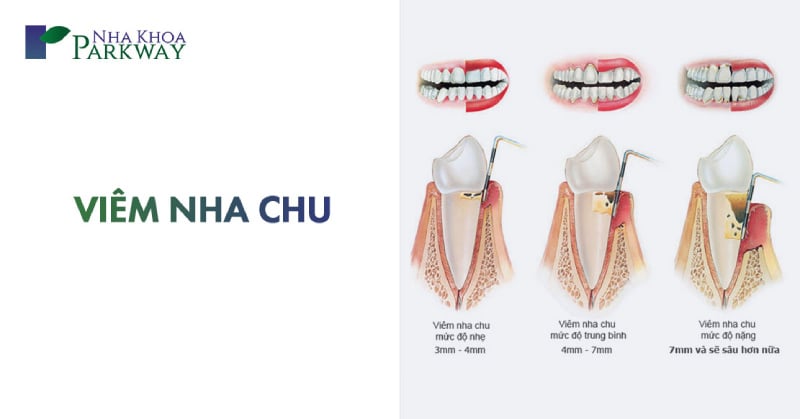 bệnh viêm nha chu là gì