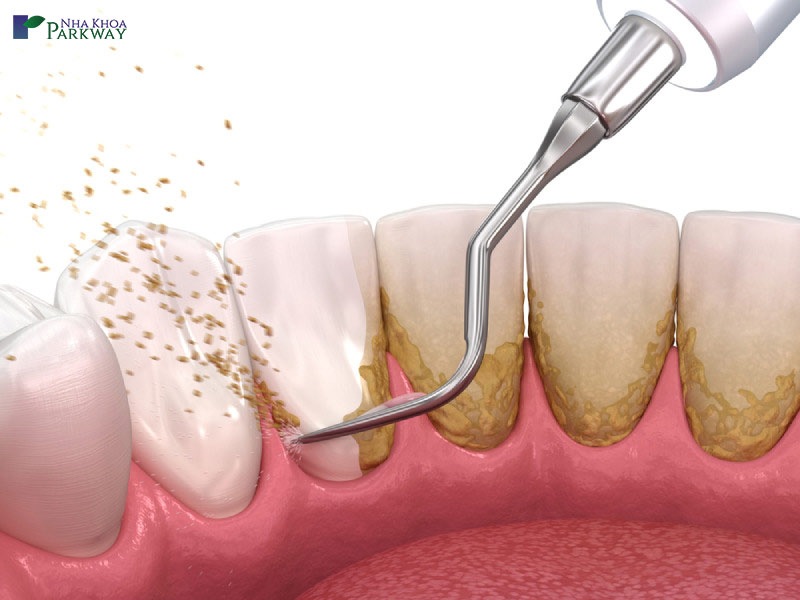 bị cao răng có tác hại gì