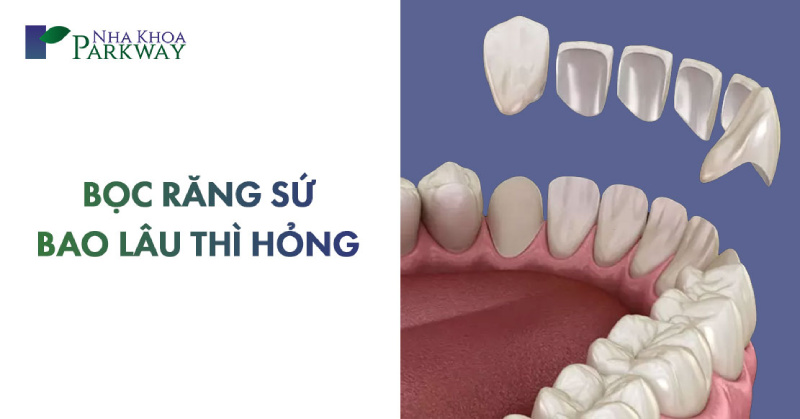 bọc răng sứ bao lâu thì hỏng