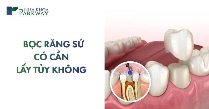 bọc răng sứ có cần lấy tủy không