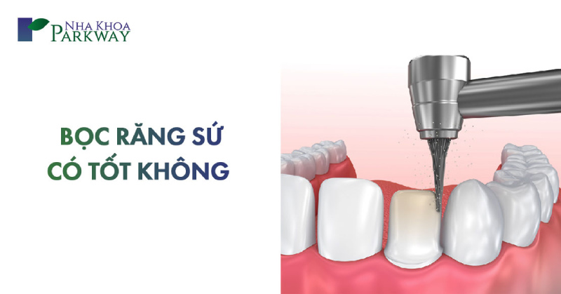 bọc răng sứ có tốt không