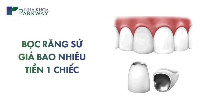 bọc răng sứ kim loại có tốt không