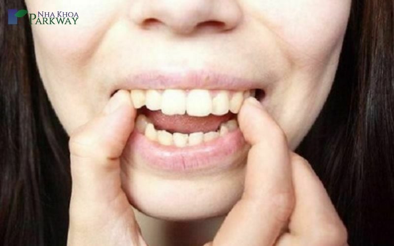 Các dụng cụ niềng răng tại nhà phổ biến nhất hiện nay