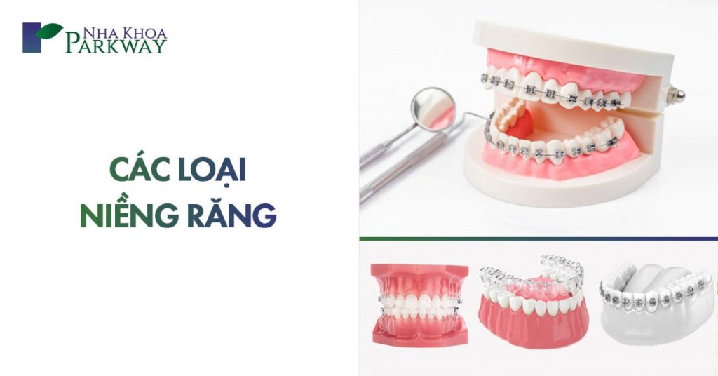 Các loại niềng răng