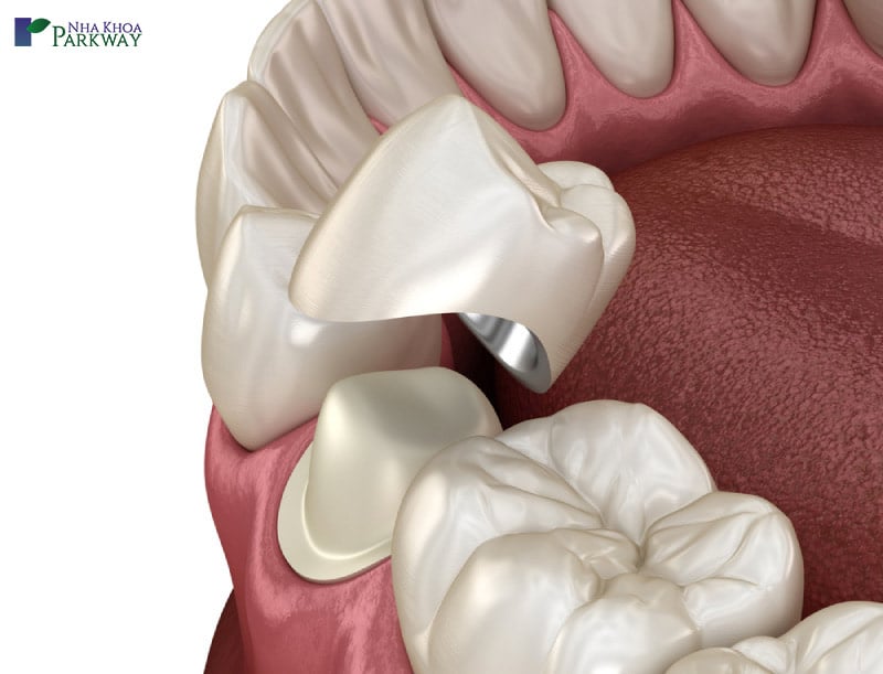 các loại răng sứ nào đẹp nhất kim loại