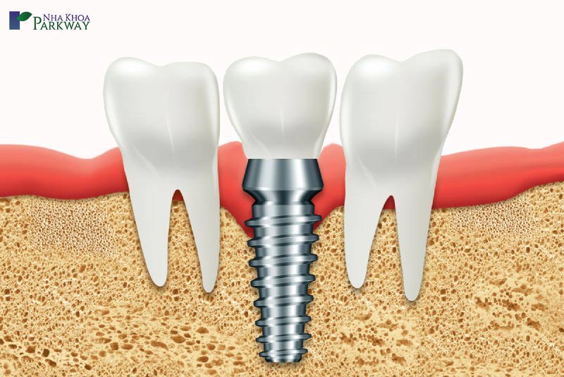 các loại trụ implant trong nha khoa