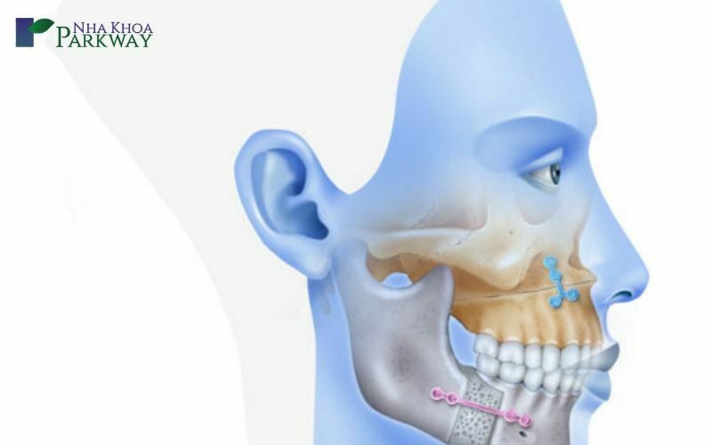 Cười hở lợi là gì?