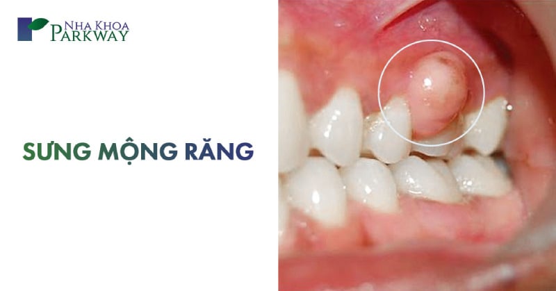 cách chữa sưng mộng răng tại nhà