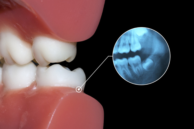 cách nhận biết răng khôn mọc thẳng