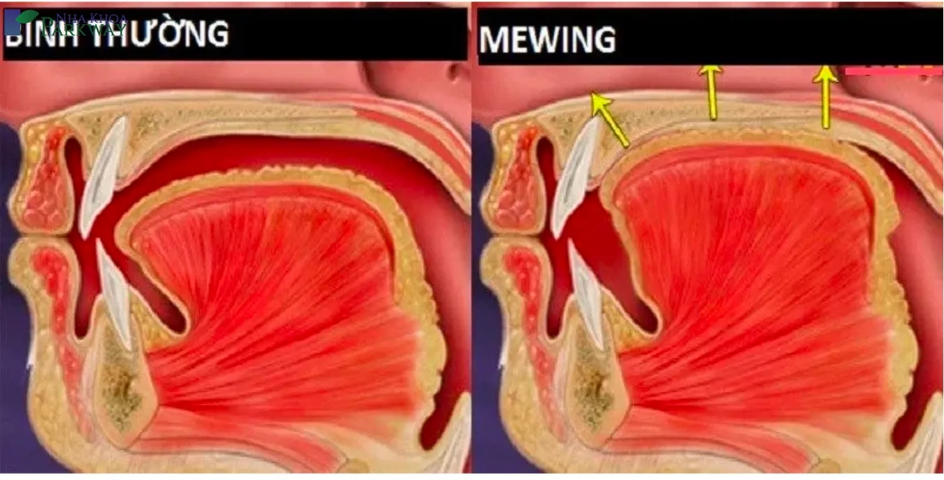 Những lỗi sai phổ biến khi tập Mewing