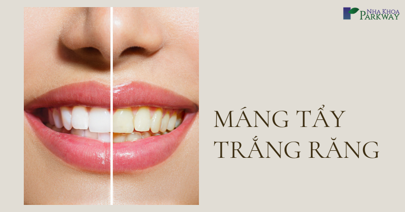 cách tẩy trắng răng bằng máng