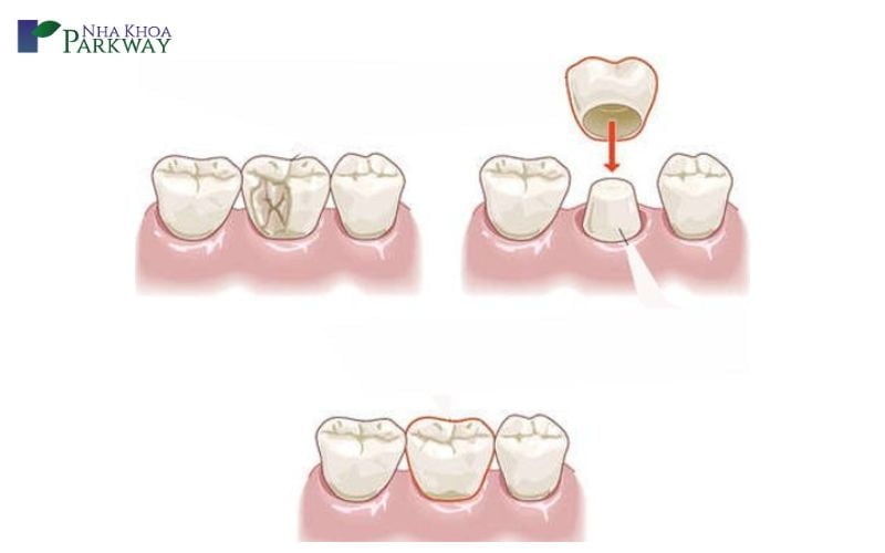 Làm gì để hết đau răng sâu?
