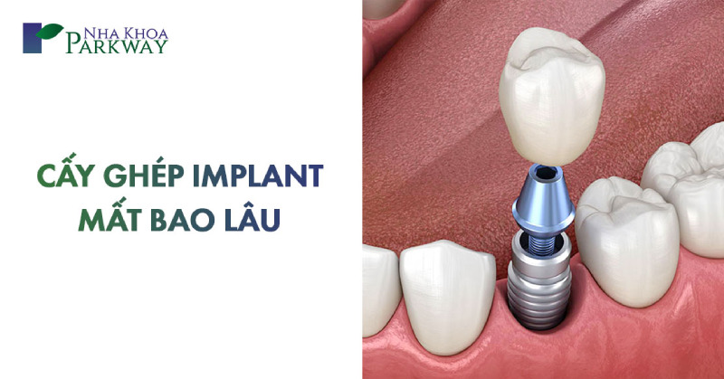 cấy ghép implant mất bao lâu thời gian