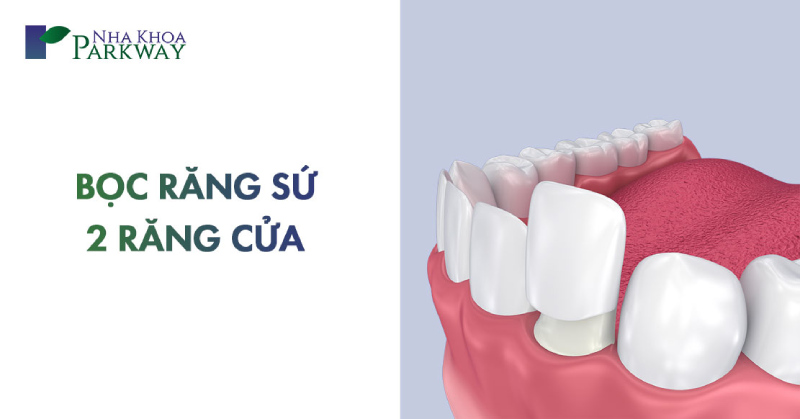 chi phí bọc răng sứ 2 răng cửa bao nhiêu tiền