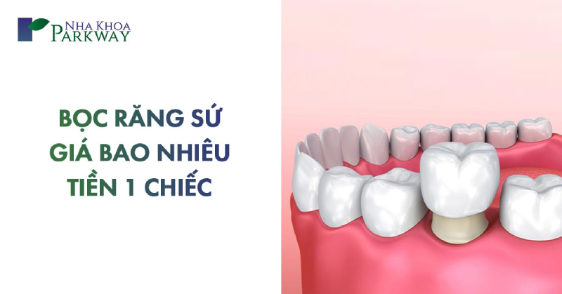 chi phí bọc răng sứ giá bao nhiêu tiền