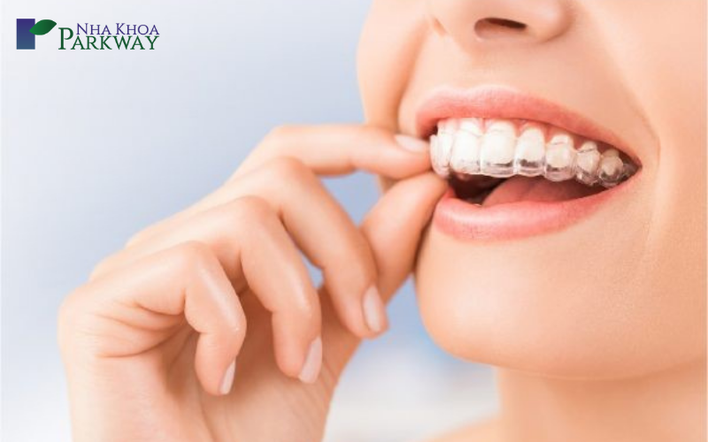 giá niềng răng invisalign