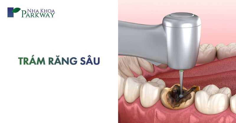 chi phí trám răng sâu bao nhiêu tiền