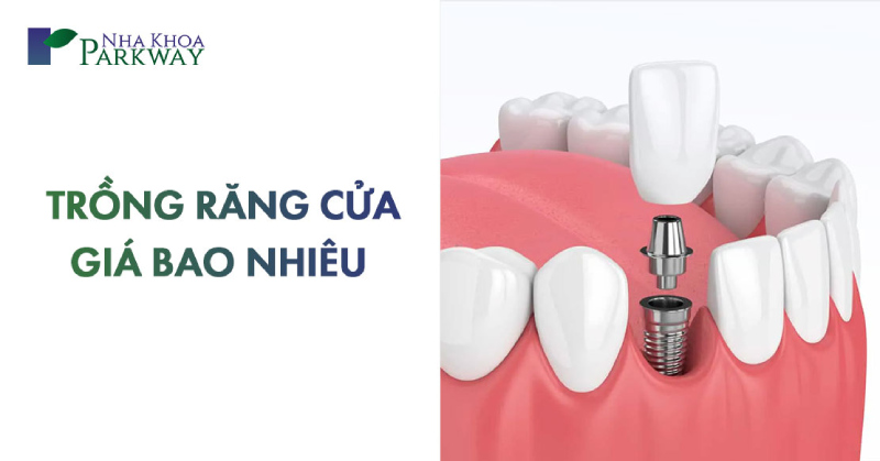 chi phí trồng răng cửa giá bao nhiêu tiền