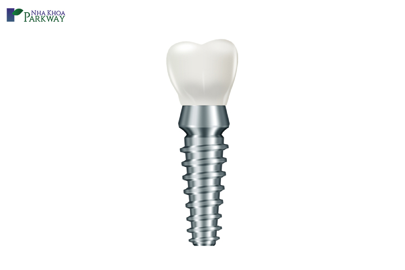 chọn trụ implant nào tốt