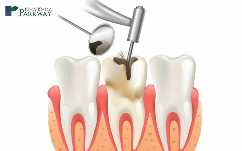 Các trường hợp nên điều trị tủy răng