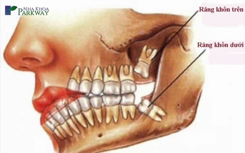 có nên tiểu phẫu răng khôn hàm dưới không