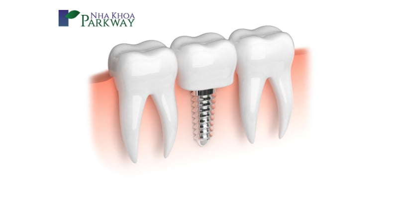 Phương pháp trồng răng giả bằng cấy ghép implant