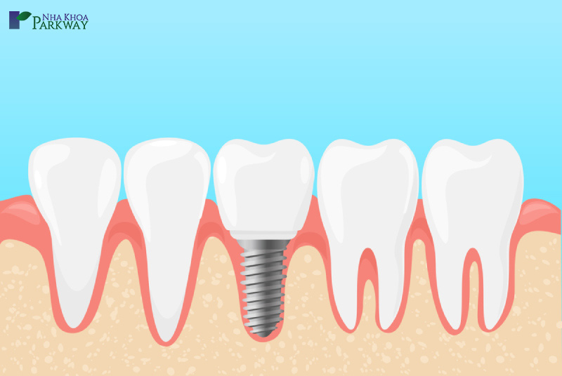 công nghệ cấy ghép implant là gì