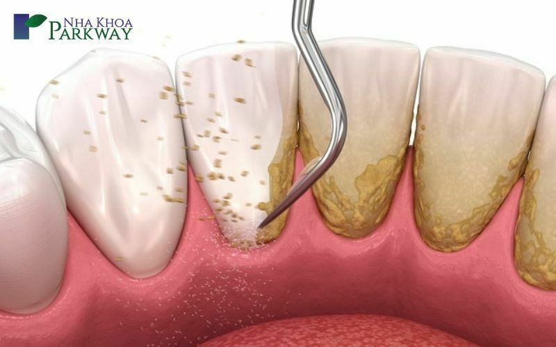 Những điều cần chú ý trước khi điều trị cười hở lợi