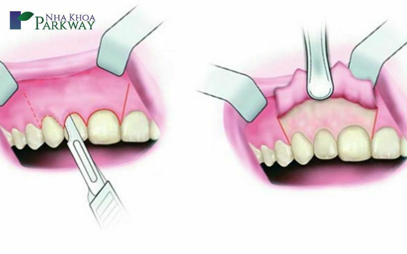 Phẫu thuật mài xương ổ răng điều trị cười hở lợi