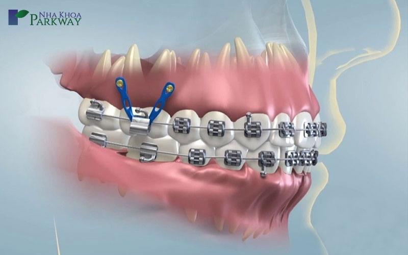 đánh lún răng bao nhiêu tiền