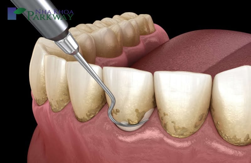 Cách chữa đau răng hàm tùy theo từng nguyên nhân