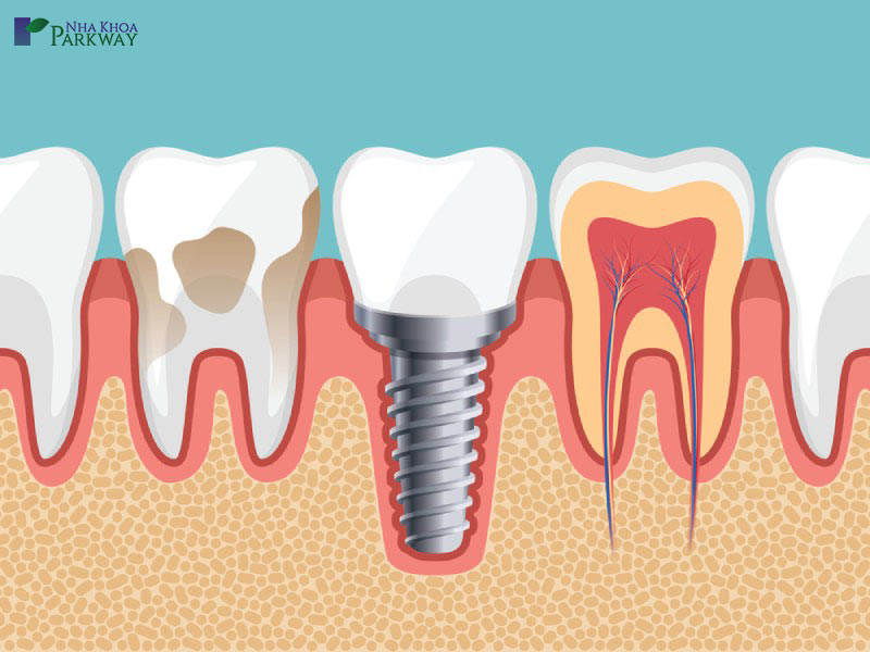 địa chỉ làm răng implant tốt tại tphcm