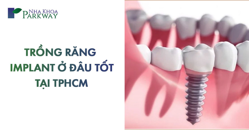 địa chỉ trồng răng implant ở đâu tốt tại tphcm