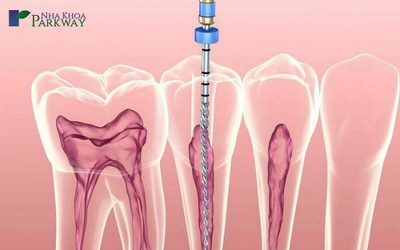 Chữa tủy răng là gì?