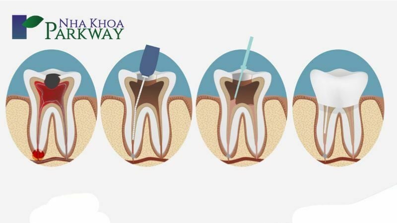 Điều trị tủy răng là gì?