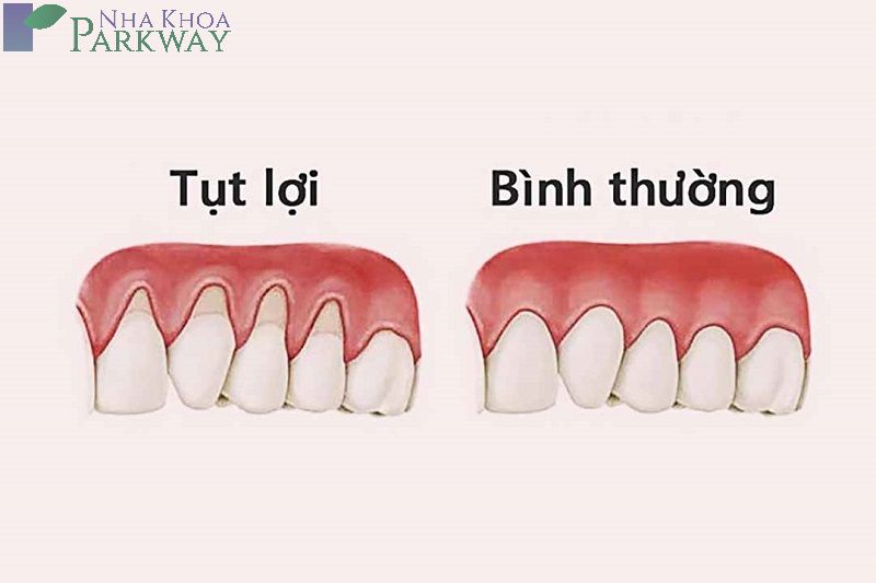 Nguyên nhân dẫn đến tình trạng ê răng cửa