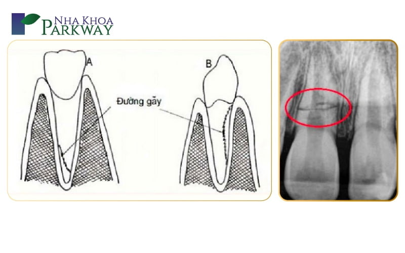 Những trường hợp thường gặp khi bị gãy răng