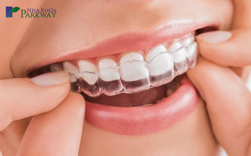 niềng răng trong suốt invisalign là gì