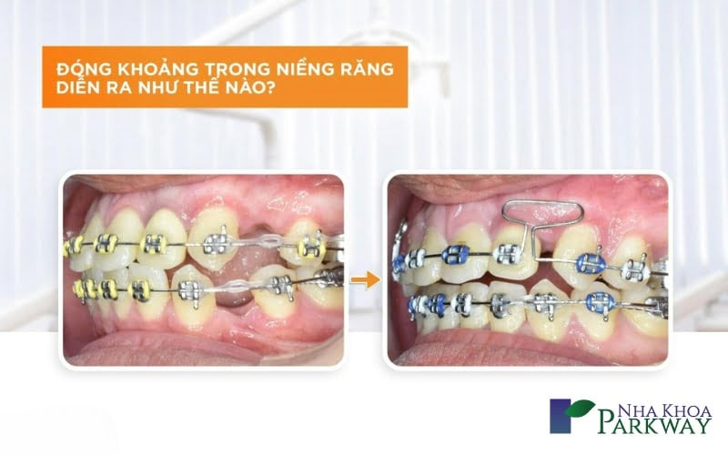 Kỹ thuật kéo cịm răng cửa trong niềng răng diễn ra như thế nào? 