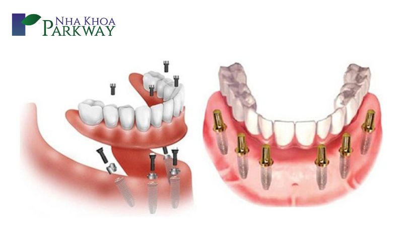 Có bao nhiêu phương pháp làm hàm răng giả cho người già?