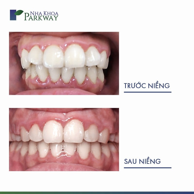 Hiệu quả sau khi niềng invisalign